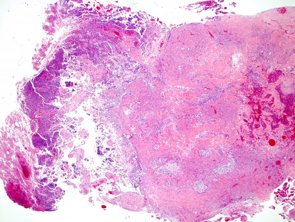 13A1 Gliosarcoma (Case 13) 2 H&E 2X.jpg