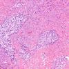 13A3 Gliosarcoma (Case 13) H&E B2