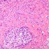 13A4 Gliosarcoma (Case 13) H&E B1