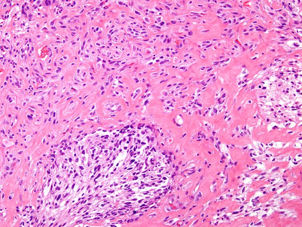 13A4 Gliosarcoma (Case 13) H&E B1