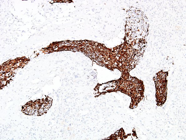 13B3 Gliosarcoma (Case 13) GFAP B2