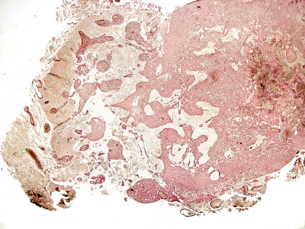 13C1 Gliosarcoma (Case 13) 2 Retic 2X.jpg