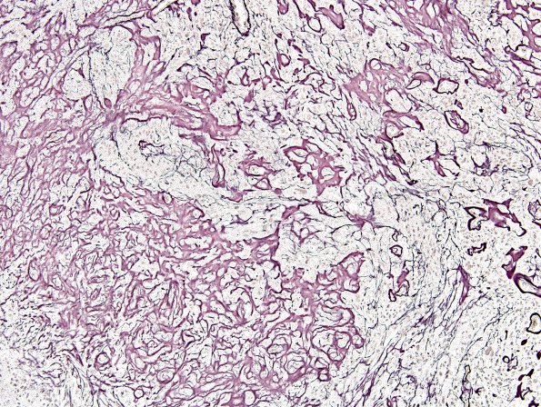 13C3 Gliosarcoma (Case 13) Retic E3