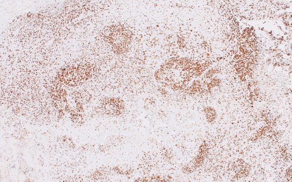 13D Gliosarcoma (Case 13) 2 p53 4X