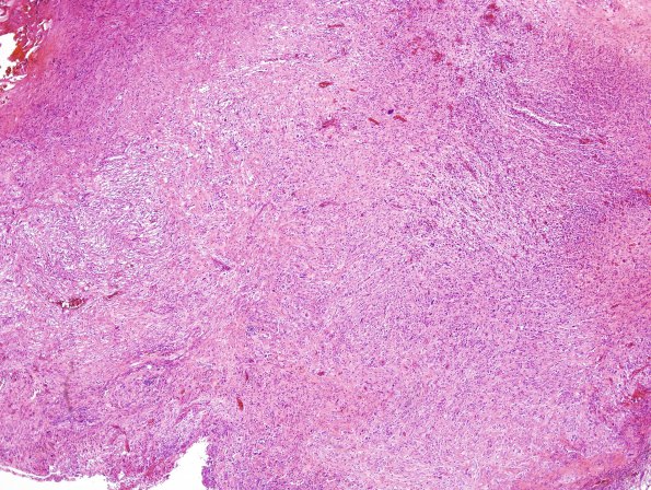 14A1 Gliosarcoma (Case 14) H&E 3