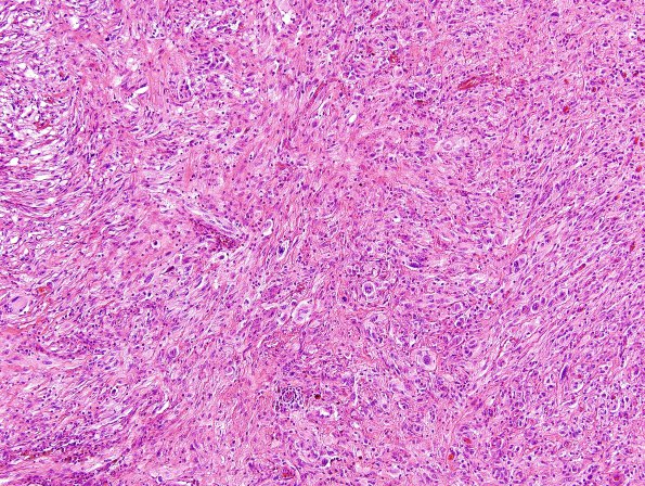 14A2 Gliosarcoma (Case 14) H&E 2