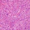 14A3 Gliosarcoma (Case 14) H&E 7