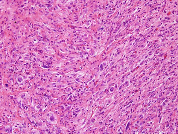 14A3 Gliosarcoma (Case 14) H&E 7