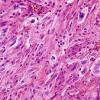 14A4 Gliosarcoma (Case 14) H&E 5