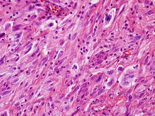 14A4 Gliosarcoma (Case 14) H&E 5