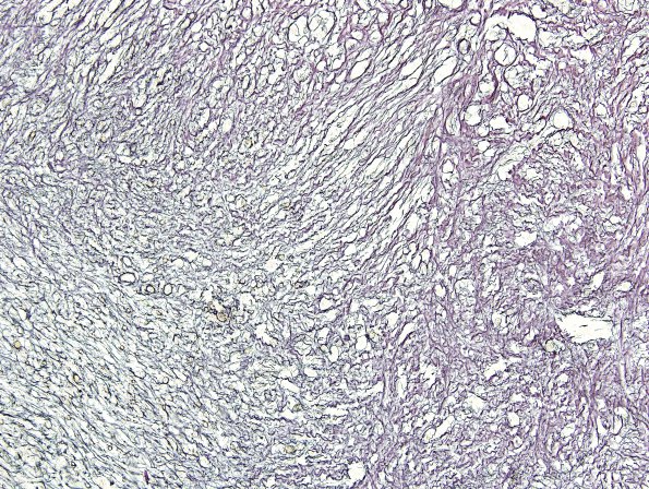 14C1 Gliosarcoma (Case 14) Retic 3