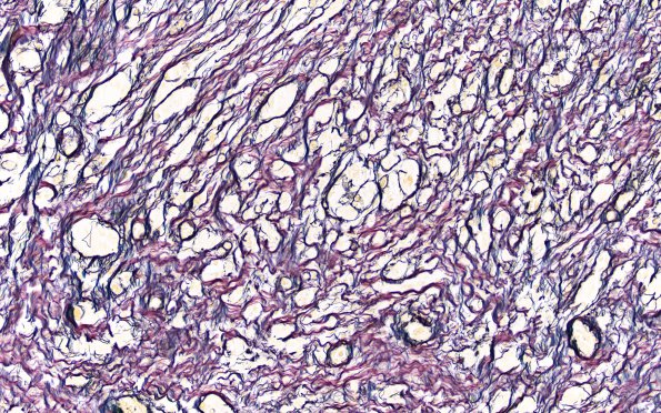 14C2 Gliosarcoma (Case 14 Retic 20X 3