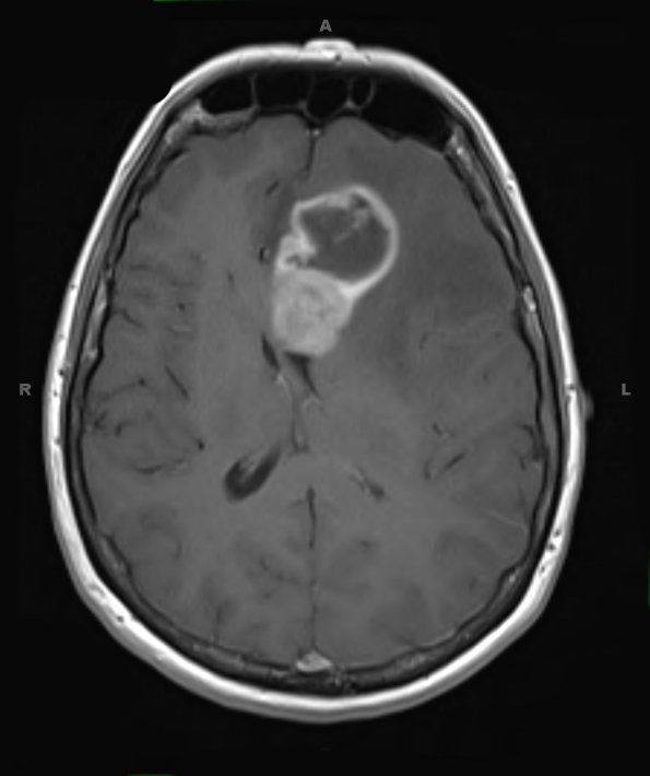 15A1 Gliosarcoma (Case 15) T1 W 3 - Copy