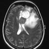 15A2 Gliosarcoma (Case 15) T2 - Copy