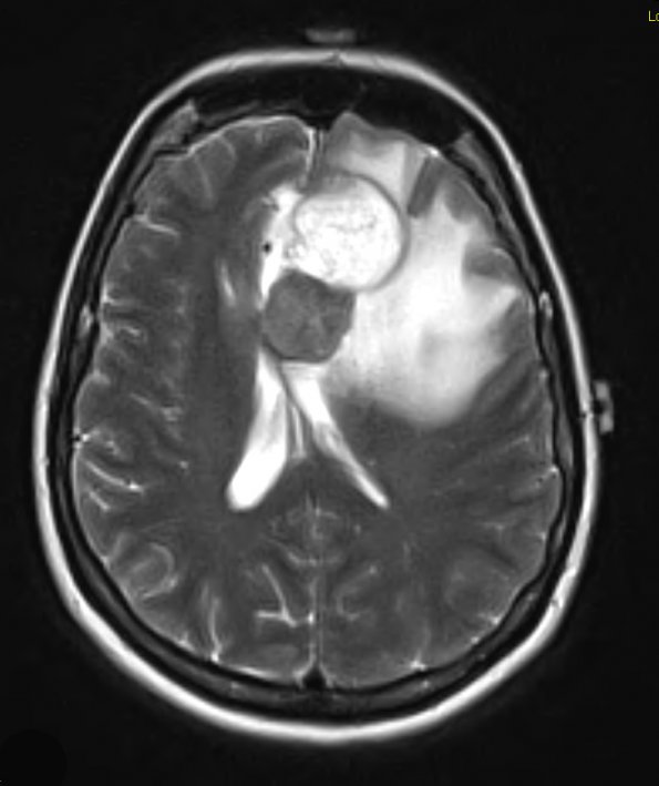 15A2 Gliosarcoma (Case 15) T2 - Copy