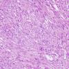 15B1 Gliosarcoma (Case 15) H&E 4