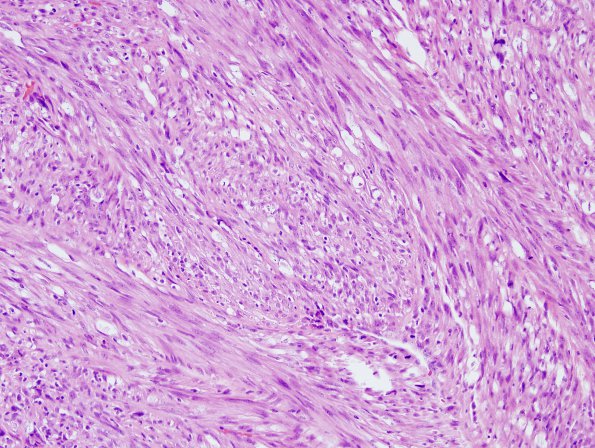 15B1 Gliosarcoma (Case 15) H&E 4