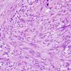 15B2 Gliosarcoma (Case 15) H&E 3