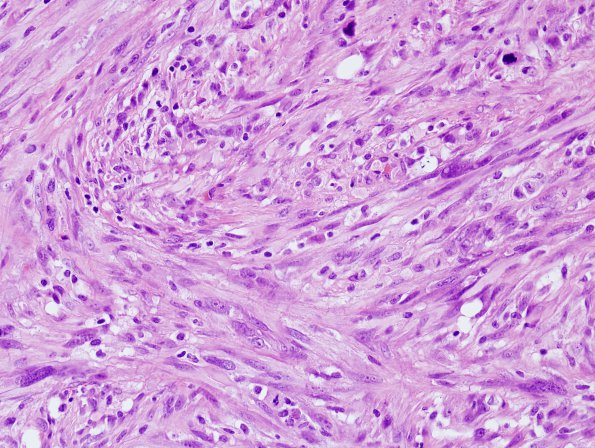 15B2 Gliosarcoma (Case 15) H&E 3