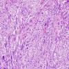 15B3 Gliosarcoma (Case 15) H&E 6