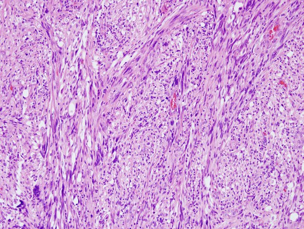 15B3 Gliosarcoma (Case 15) H&E 6