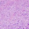 15B4 Gliosarcoma (Case 15) H&E 7