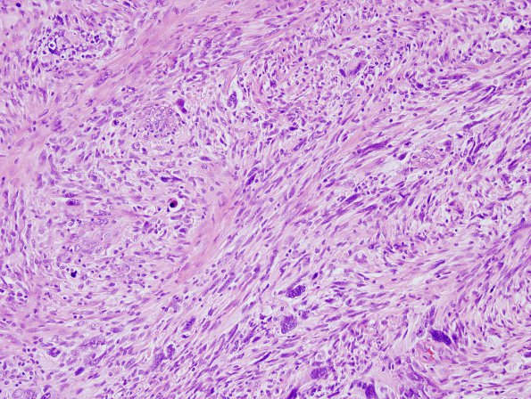 15B4 Gliosarcoma (Case 15) H&E 7