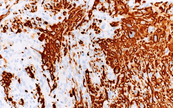 15C2 Gliosarcoma (Case 15) GFAP 40X