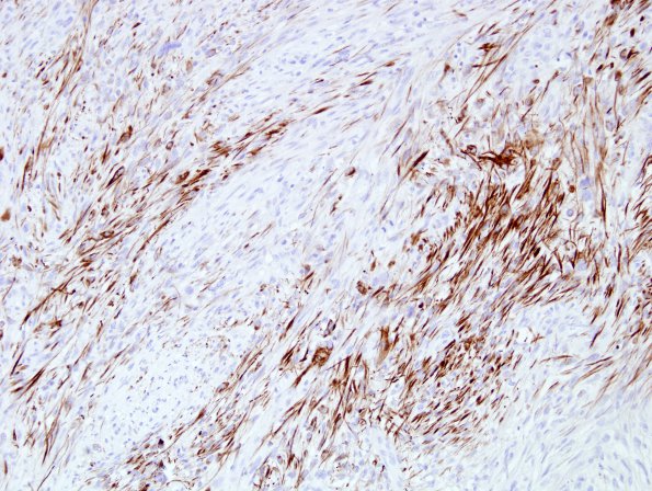 15D1 Gliosarcoma (Case 15) Desmin 3