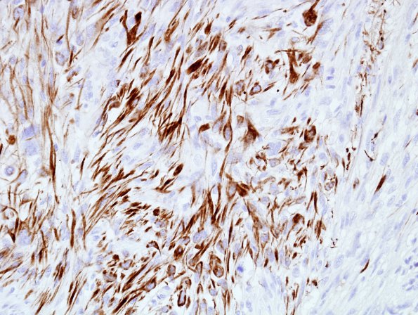 15D2 Gliosarcoma (Case 15) Desmin 2