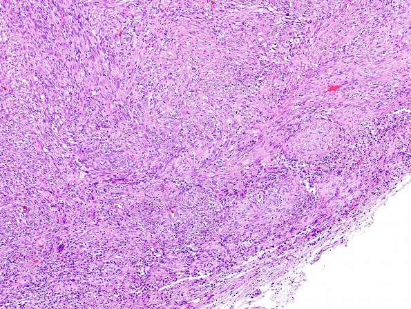 15E1 Gliosarcoma (Case 15) H&E area B