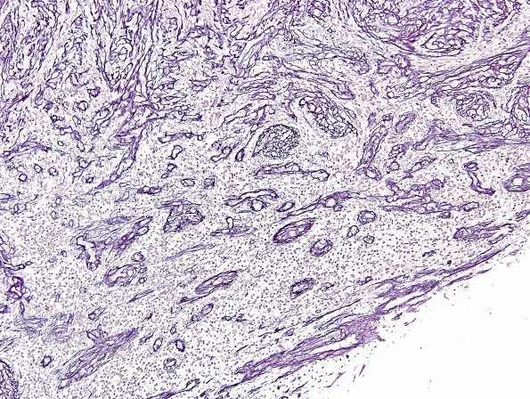 15E3 Gliosarcoma (Case 15) Retic area B