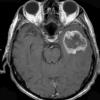 16A1 Gliosarcoma (Case 16) T1 W 2 - Copy