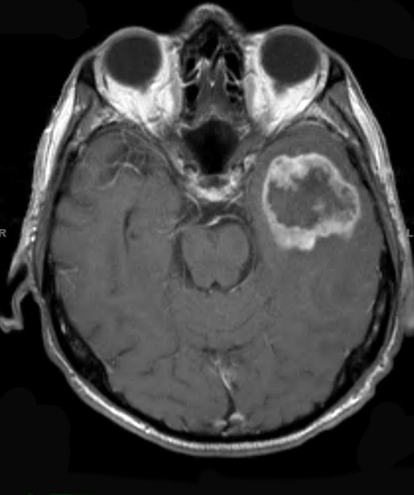 16A1 Gliosarcoma (Case 16) T1 W 2 - Copy