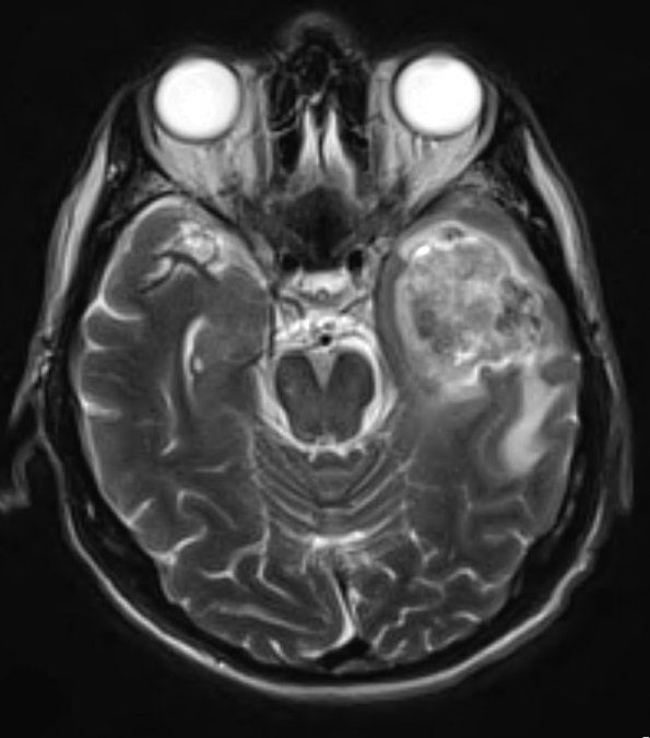 16A2 Gliosarcoma (Case 16) T2 W 2 - Copy