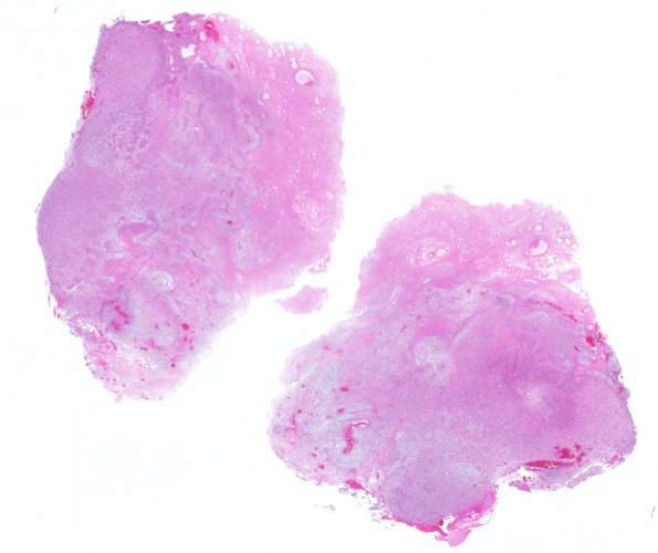 16B1 Gliosarcoma (Case 16) 1 H&E whole mount