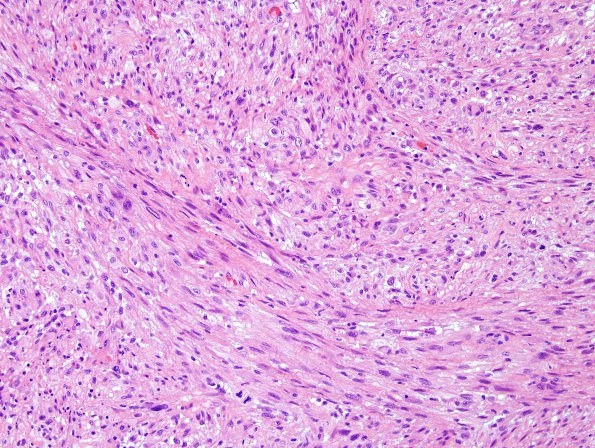 16B2 Gliosarcoma (Case 16) H&E J1