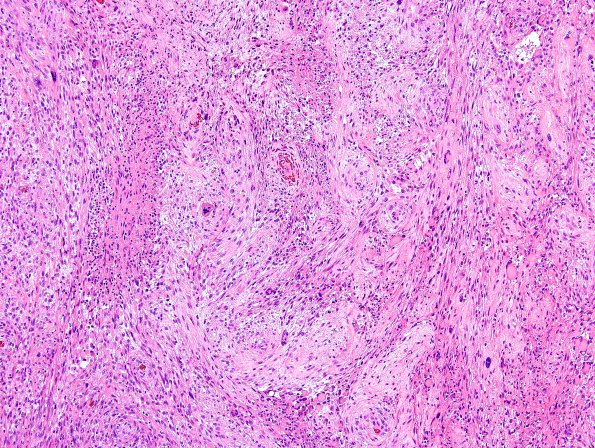 16B3 Gliosarcoma (Case 16) H&E D1