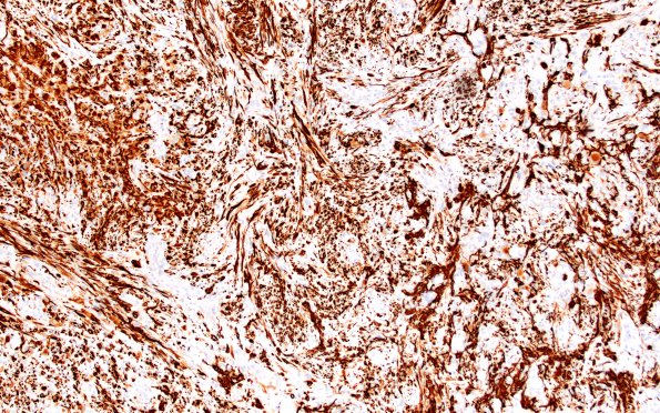 16C2 Gliosarcoma (Case 16) GFAP 10X