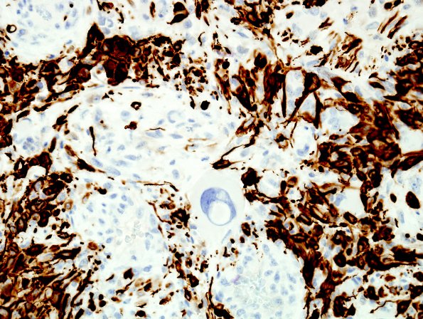 16C3 Gliosarcoma (Case 16) GFAP 1