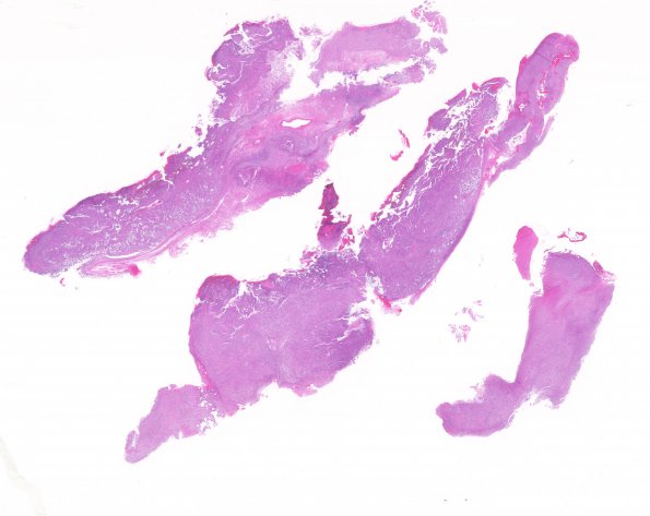 17A1 Gliosarcoma (Case 17) New B5 1 H&E whole mount