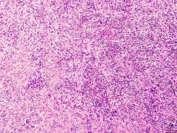 17A2 Gliosarcoma (Case 17) H&E 41