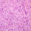 17A3 Gliosarcoma (Case 17) H&E 40