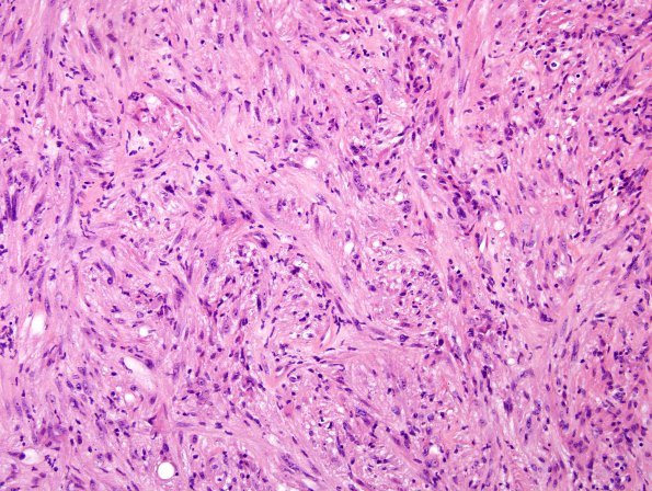 17A3 Gliosarcoma (Case 17) H&E 40