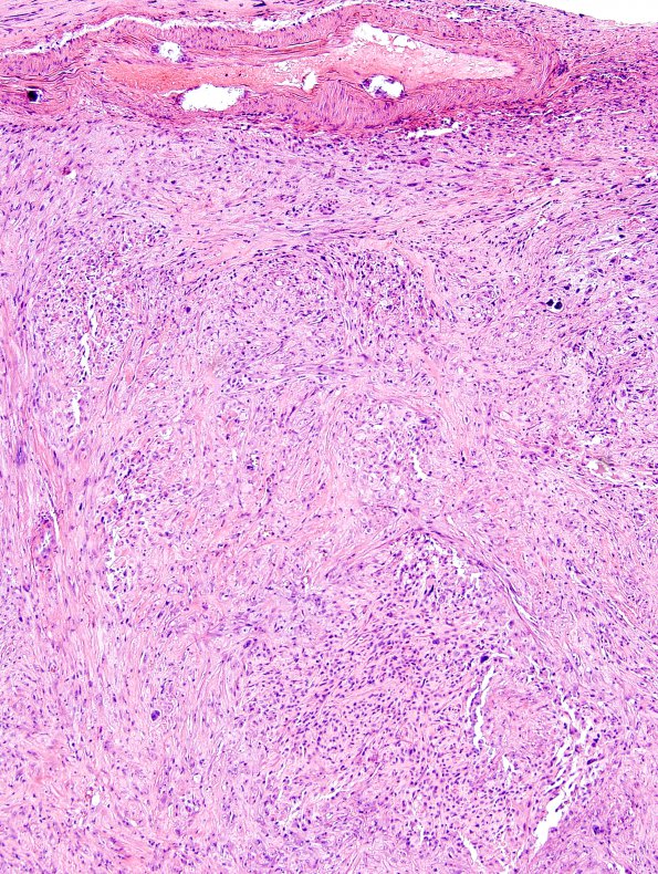 17B1 Gliosarcoma (Case 17) New B5 Area A H&E 5