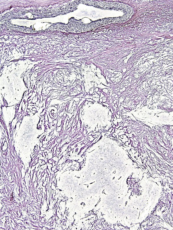 17B3 Gliosarcoma (Case 17) New B5 Area A Retic 2