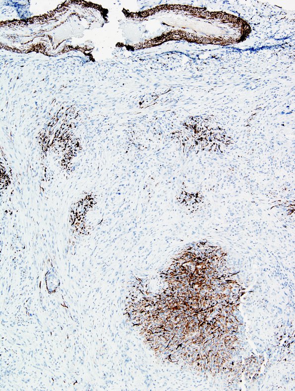 17B4 Gliosarcoma (Case 17) New B5 Area A Desmin 3