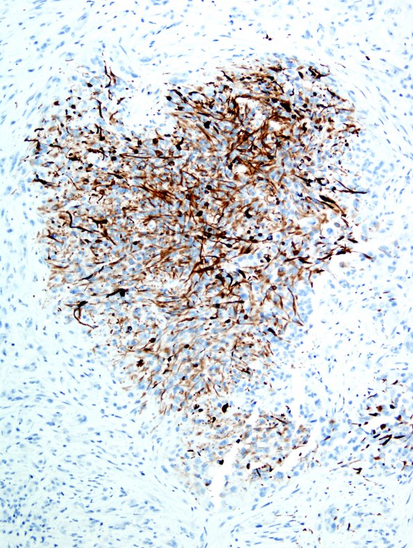 17B5 Gliosarcoma (Case 17) New B5 Area A Desmin 1