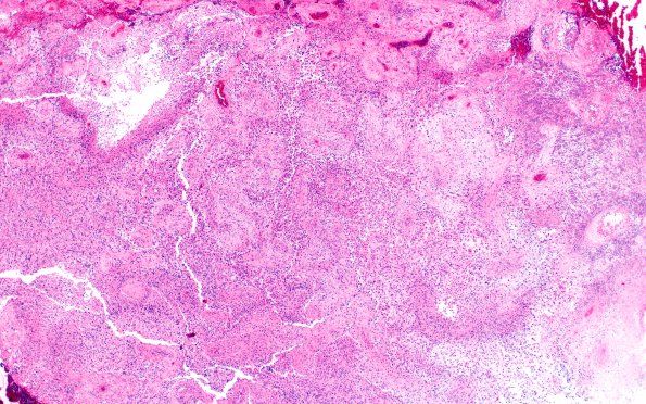 18A1 Gliosarcoma (Case 18) H&E 4X