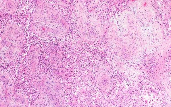 18A4 Gliosarcoma (Case 18) H&E 10X